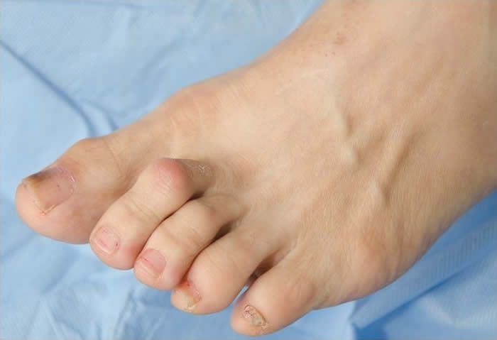 hammertoes Signs and Symptoms